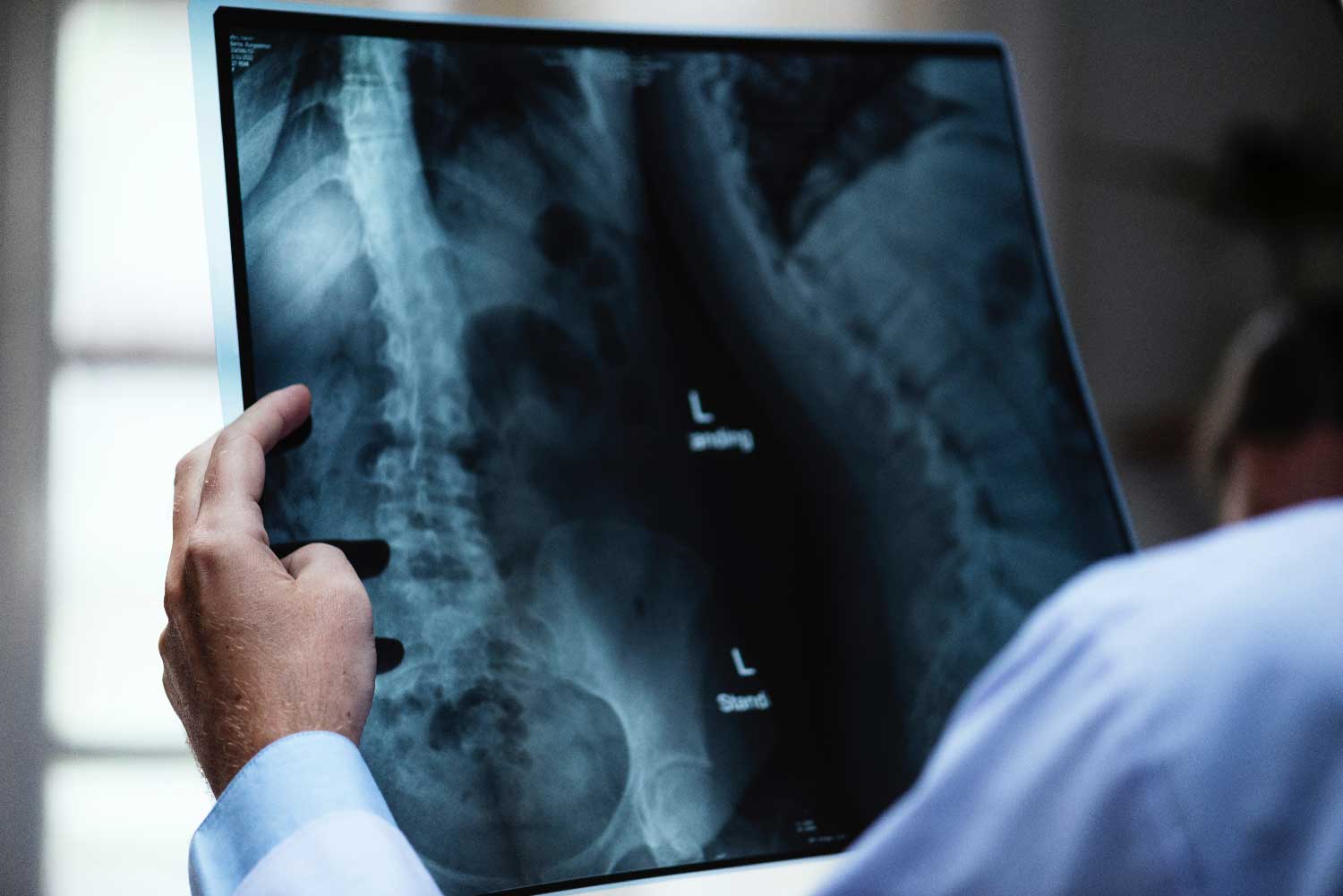 Spinal Cord Injury X-Ray